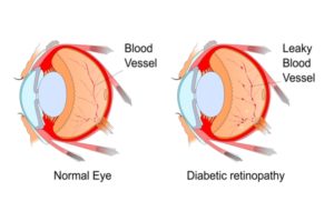 A diagram of the difference between a normal eye and an eye suffering from diabetic retinopathy