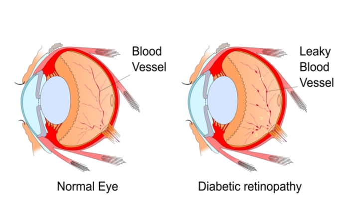 Blurry vision in one eye: Causes, treatments, and what to do