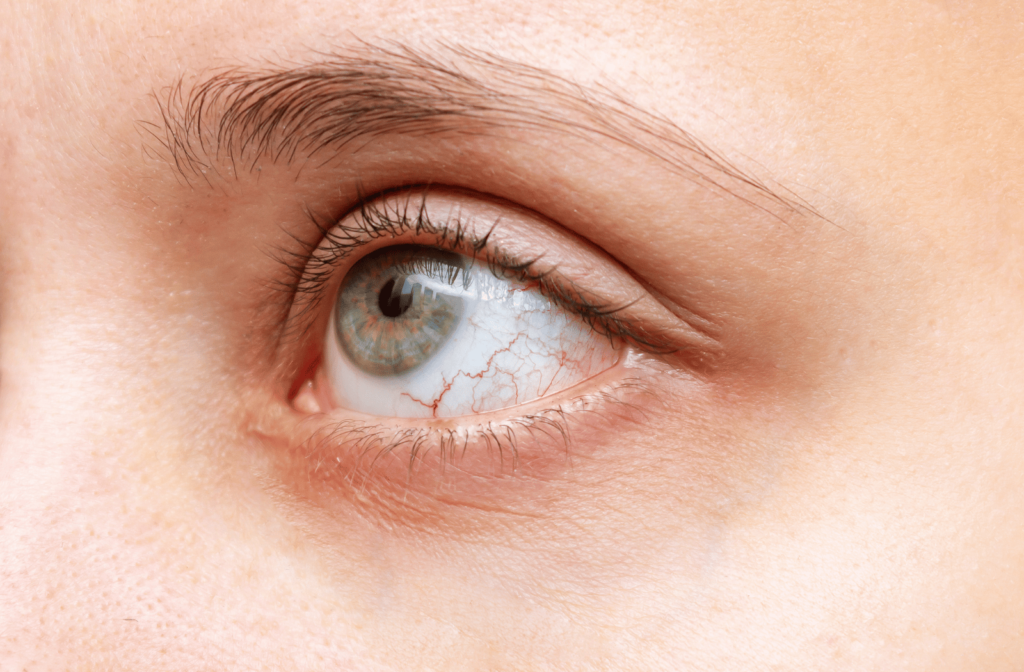 A close-up view of a person's visibly dry and blood-shot eye.