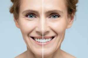 A side-by-side before and after picture of a woman's face showing tighter skin and less fine lines and wrinkles.