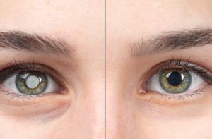 A close-up of a patient's upper face, focused on their eyes. The patient's right eye has the cloudy pupil, characteristic of a cataract. The patient's left pupil is a normal black color.