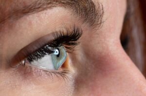 A close-up image of a person’s eye affected by keratoconus, showing a cone-shaped cornea that can worsen astigmatism.