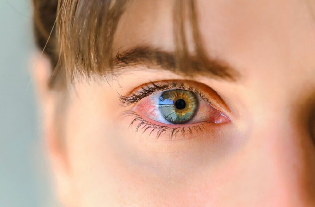 A clinical close-up of a person's blue and hazel eye with significant redness and visible blood vessel irritation, symptomatic of contagious pink eye.